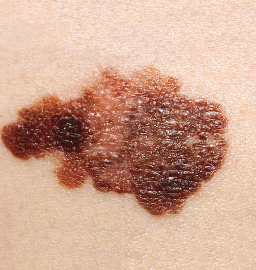 Melanoma