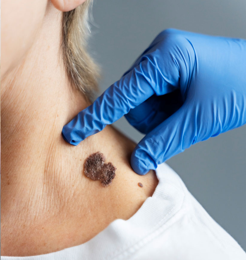 Simple-Excision SKIN