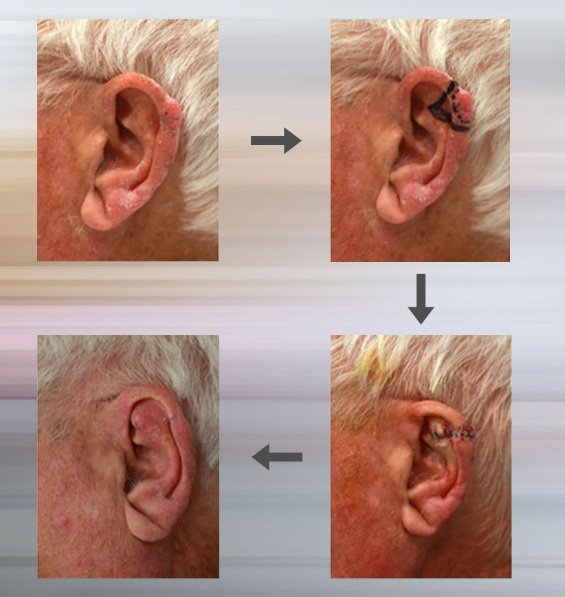wedge resection skin cancer surgery