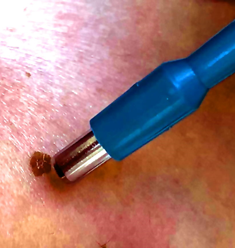 Skin biopsy procedure at Sun Smile Clinic Leppington