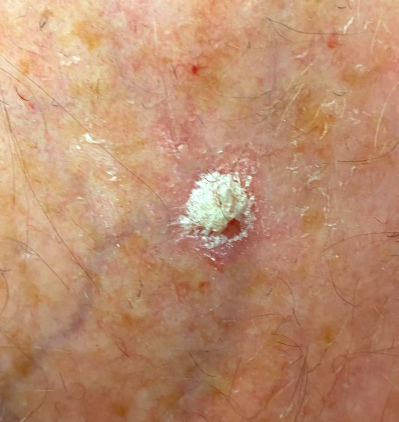 Actinic keratosis