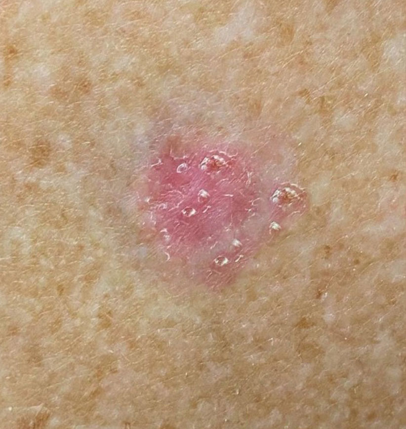 BCC-Basal Cell Carcinoma